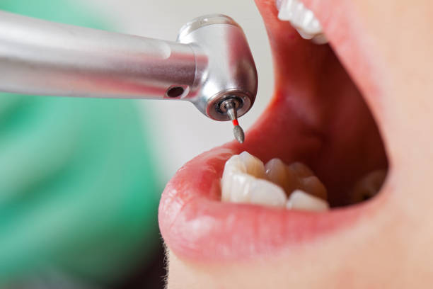 Best Emergency Wisdom Teeth Removal in Montverde, FL